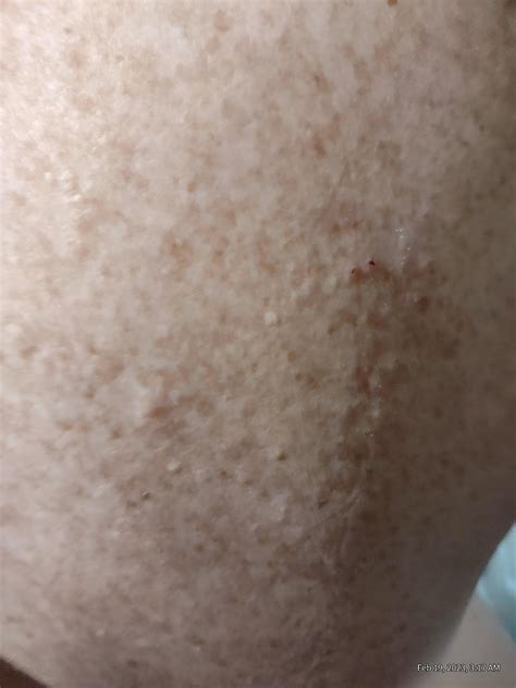 EXTREMELY ITCHY raised rash located on my upper back. It's been going