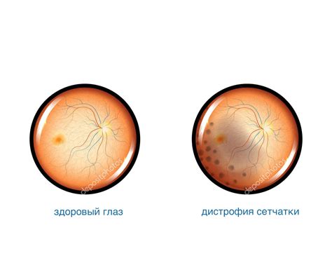 Лечение периферической дистрофии сетчатки глаза в Москве