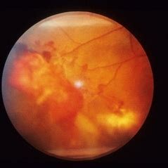 Neovascularization - Retina Image Bank