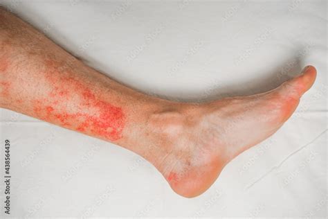 Disease of the skin on the legs, itchy red rashes and spots Stock-Foto