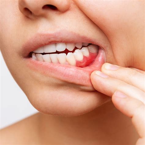 how to stop gum bleeding