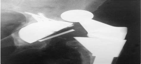 closed reduction  constrained total hip arthroplasty clinical