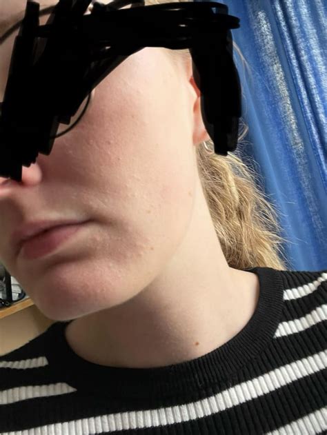 Could this be an allergic reaction to azithromycin? : r/Rosacea