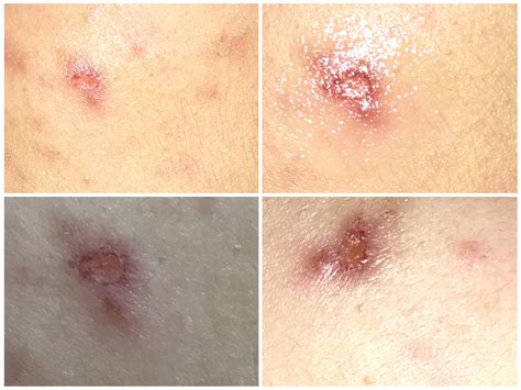 how long does pimple scars take to heal