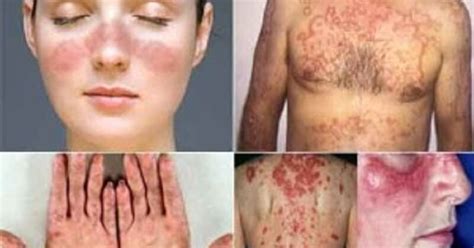 Penyakit Kusta Menular Atau Tidak - Homecare24
