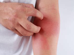 gejala alergi kulit  perlu  waspadai  sehat