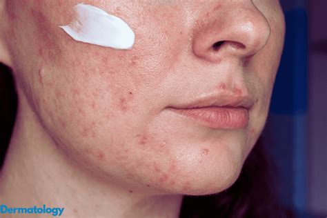 10 Best Rosacea Treatment Tips - Dermatology UK