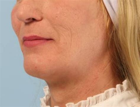 Before & After Chin Reduction Houston | Face Forward