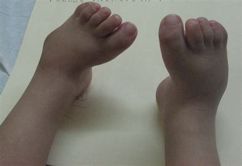 Talipes Calcaneovalgus Foot at Xavier Guerard blog