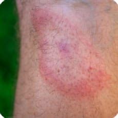 Zecken – Gut geschützt vor Borreliose und FSME