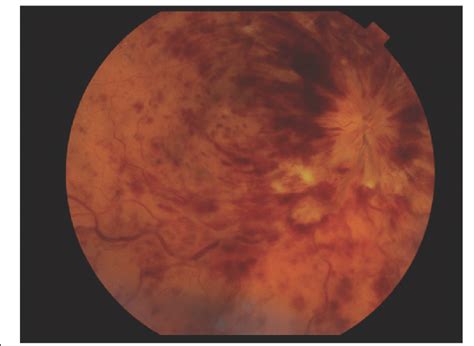 fundus image  topcon oct  showing multiple deep dark