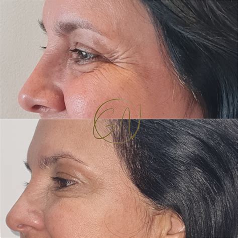 Esteticista Pode Fazer Botox