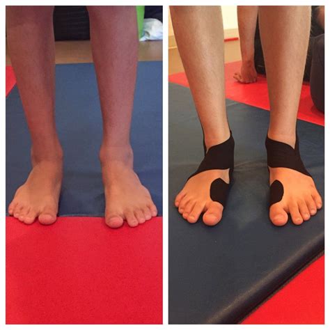 Peroneal tendinopathy kinesiology taping technique – Artofit