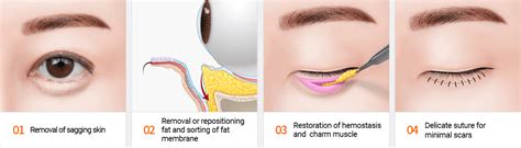 Common Types Of Eye Bags And How To Remove Them | DAPS