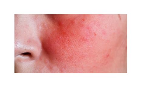 Retinol & Retinol Burn – Auxergen