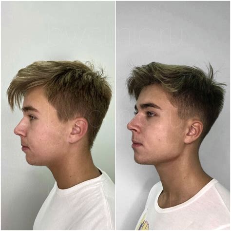 Ботокс лица для мужчин: цены в Москве | Стоимость инъекций Botox для ...