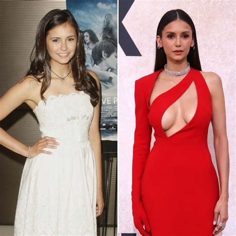 Blepharoplasty and Nina Dobrev: Setting the Record Straight | Bizrahmed