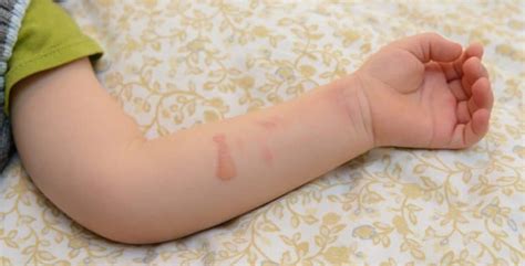 burns  children treatment  prevention baby arabia