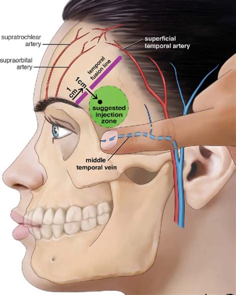 Onde Fica A Têmpora No Corpo Humano - Preenchimento têmpora - Injectors Club