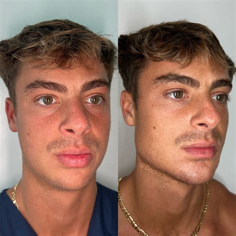 Jawline Contouring - Designer Aesthetics by Dr. Jarrett Schanzer | Miami