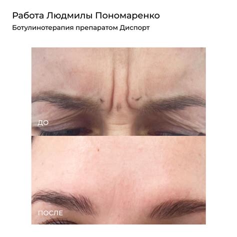 Ботулинотерапия - Услуги