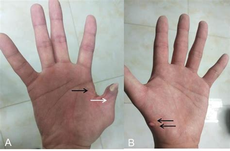 (A) The black arrow indicates the surgical scar from surplus finger ...