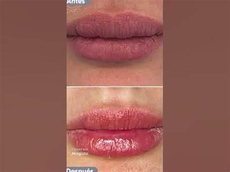 Extracción de biopolímeros en los labios - YouTube