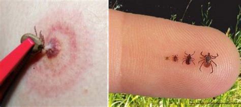 Justin Bieber revela que contraiu Doença de Lyme; a enfermidade causada ...