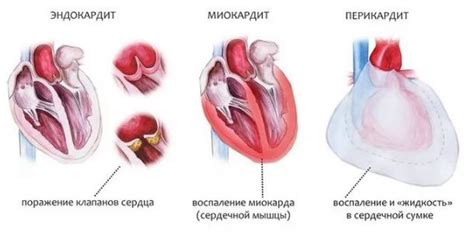 Кардит: классификация, признаки, как лечить - DavlenieNorm