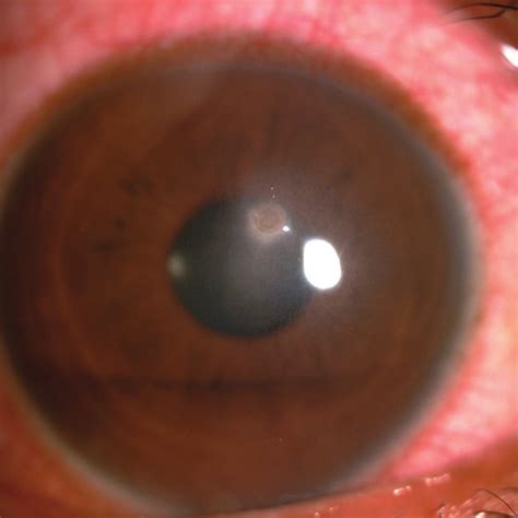 faint corneal scar    case  scientific diagram