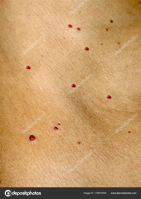 Little Red Moles On Skin