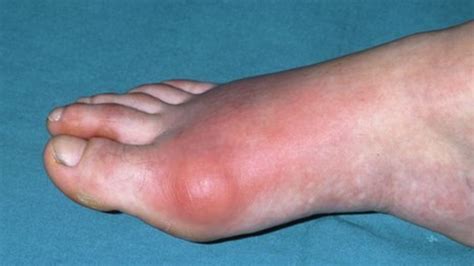 Rates of gout in UK 'soaring' - BBC News