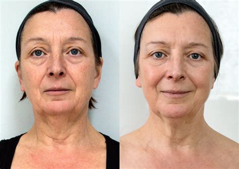 clearlift  laser facelift andresa aesthetics exclusive skin