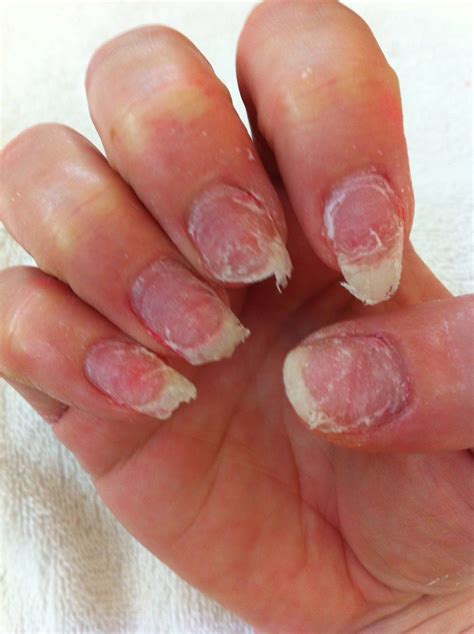How to Prevent Infection and Allergic Reactions with Artificial Nails
