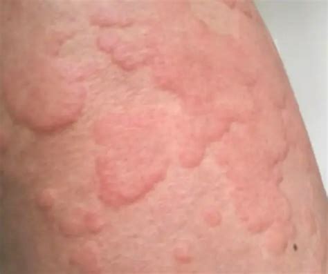 Urticária Colinérgica Tratamento - Urticárias – Sintomas, Causas e Tratamento