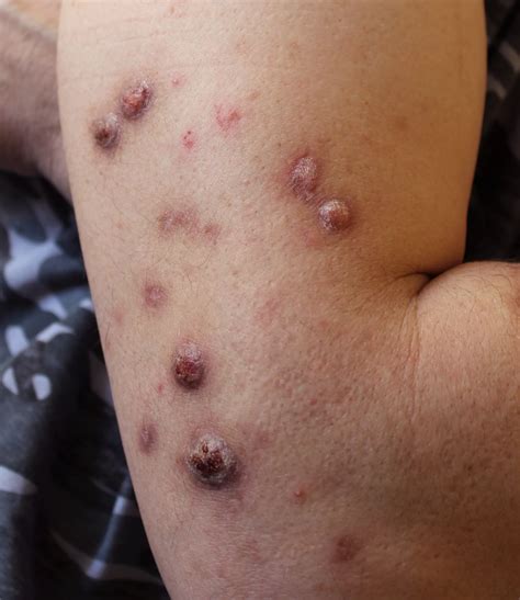 Prurigo Nodularis: Symptoms, Diagnosis & Management Tips