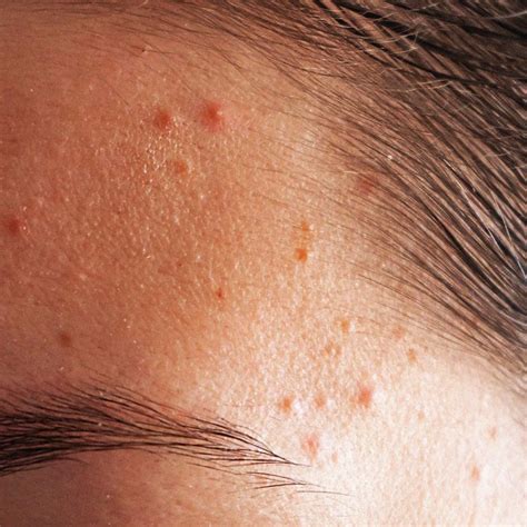 hilangkan tiny bump fahamkan dulu punca munculnya masalah