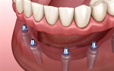 Affordable Denture Implants: Breaking Down the Cost-Effective ...