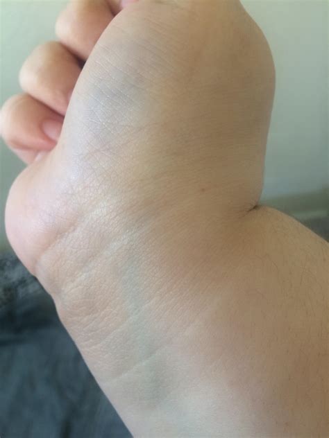 Ganglion Cyst? I found this bump on my wrist a while back. My wrist