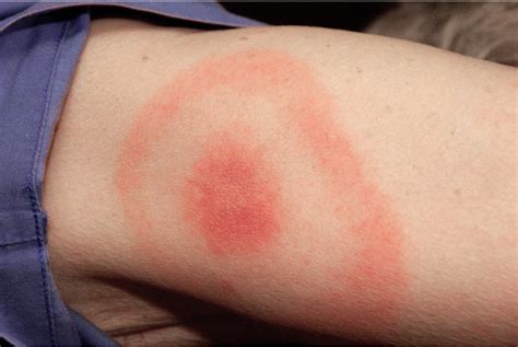 infected insect bites treatment broadstairs pharmacy