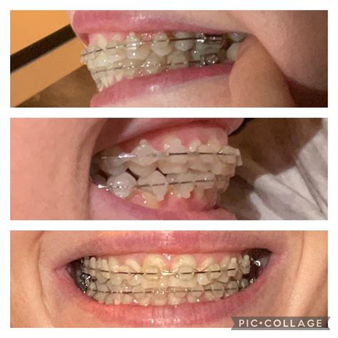 Last appointment, Ortho booked removal for 25th Jan. I’m not sure why