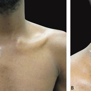 Clinical aspect of the patient. (A − B) dermatosis located on the right ...