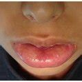 Persistent lower lip swelling Figure 3: A polyp on the lower labial ...