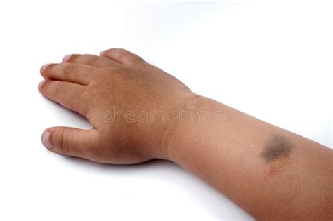 Birth Mark on the Right Hand Stock Image - Image of mark, macro: 51368409