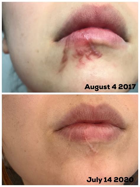 How Long Does It Take For A Dog Bite To Heal On A Human