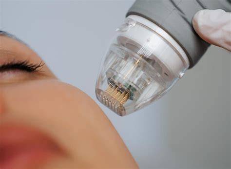 radiant skin  vivace rf microneedling  otto clinic
