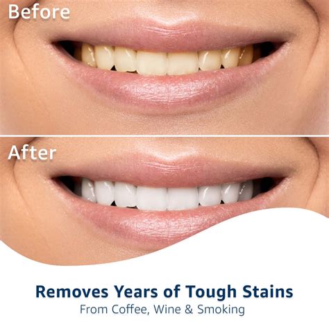 Equate Ultra-White Whitening Strips, Enamel-Safe, 24 | Ubuy Chile