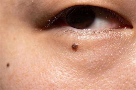 Face Mole Stock Photos, Images and Backgrounds for Free Download