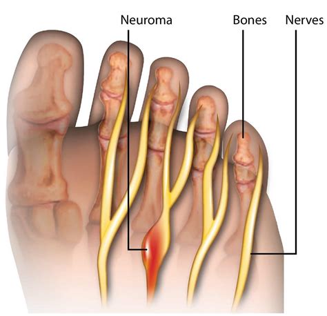 Morton's Neuroma - Causes, Symptoms, Diagnosis, Treatment