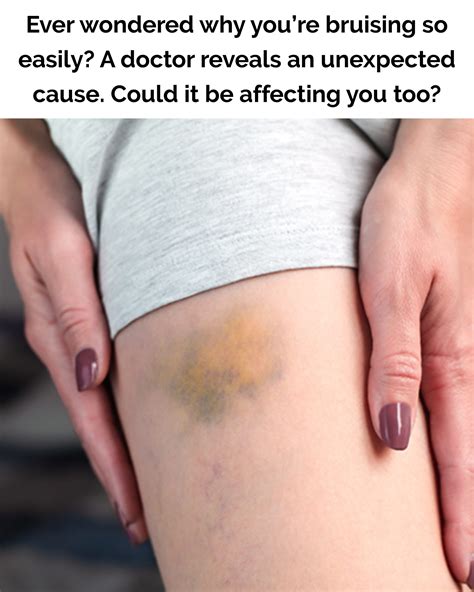 Doctor Reveals Reason Why You’re Bruising So Easily – Read This Story Now